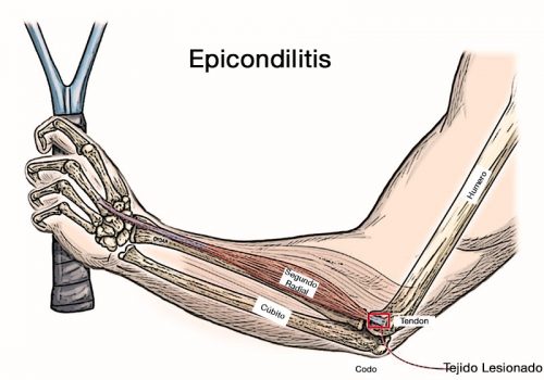 epicondilitis scaled